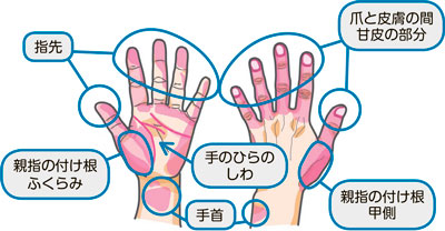 図解：洗い残しの多い部分
		     出典：公益社団法人日本食品衛生協会発刊「食中毒・感染症を防ぐ!!衛生的な手洗い」